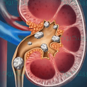 سنگ کلیه؛ علائم، عوامل و راه های درمان سنگ کلیه