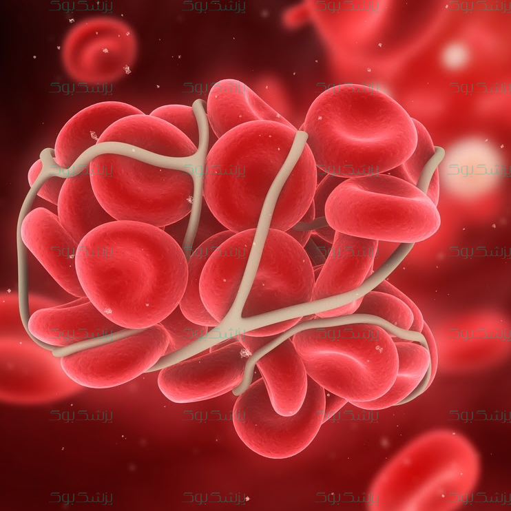 اختلال لخته شدن خون چیست و چرا ایجاد می‌شود؟