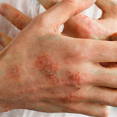 چطور اگزمای پوستی را در خانه درمان کنیم؟