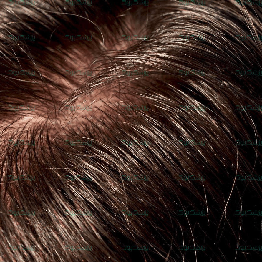 با موهای چرب چه کنیم؟