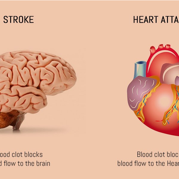 درباره سکته قلبی و مغزی بیشتر بدانیم