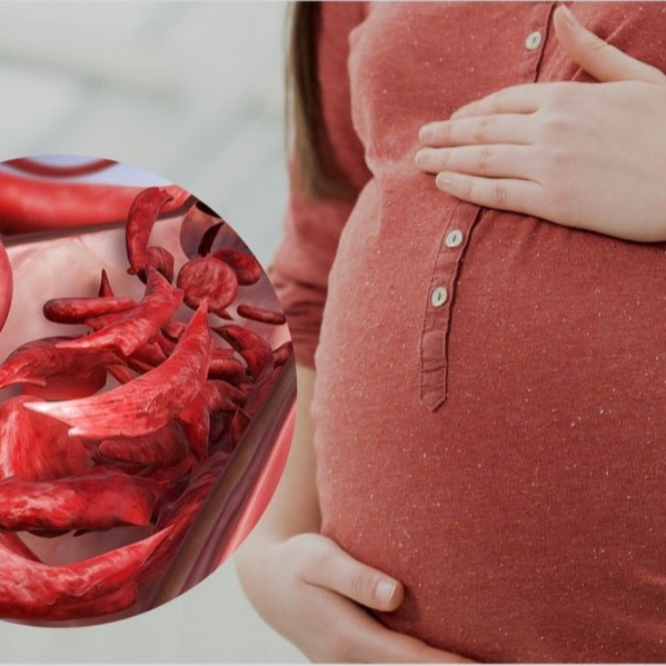 سه روش پیشگیری از کم خونی در بارداری